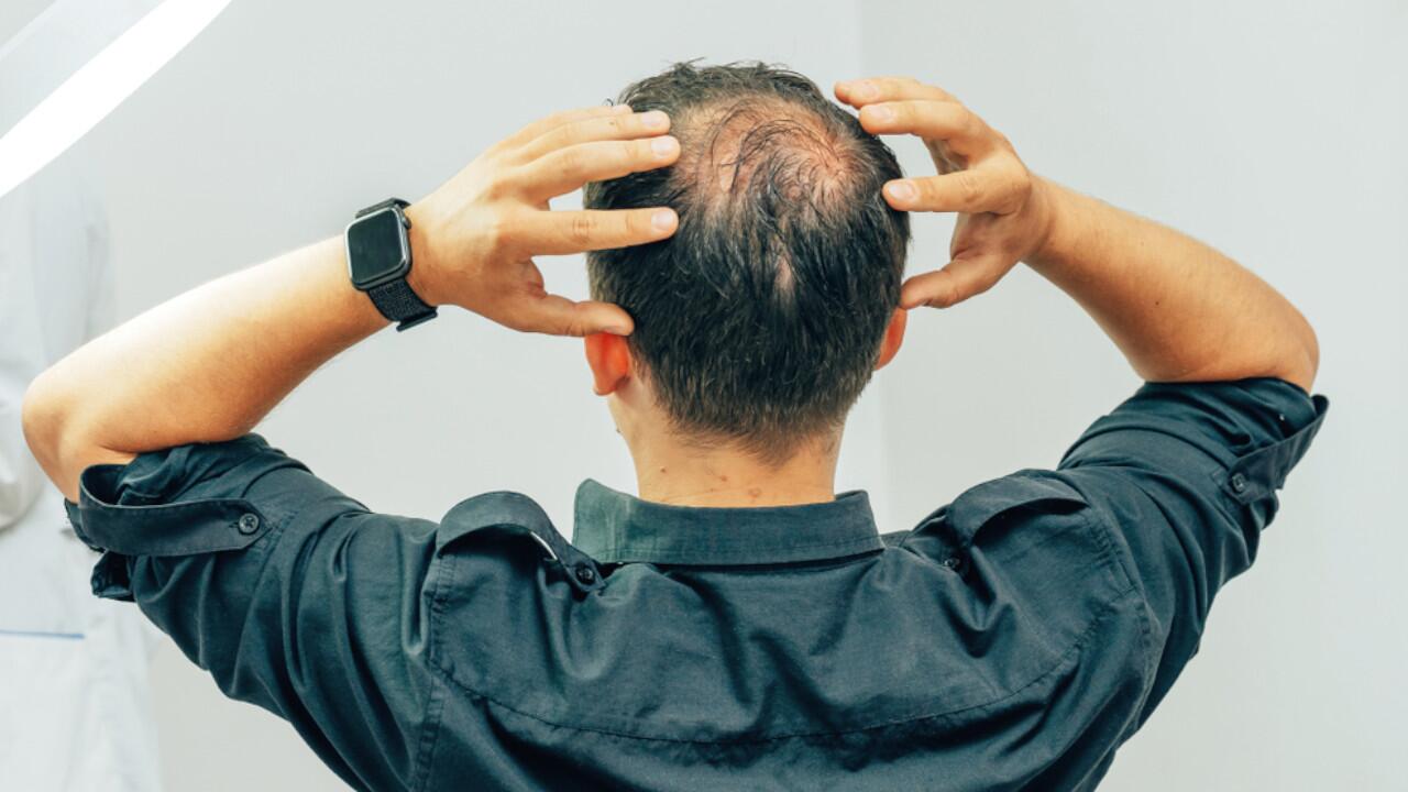 Haarausfall trifft nicht nur Männer, auch Frauen leiden unter Haarverlust.